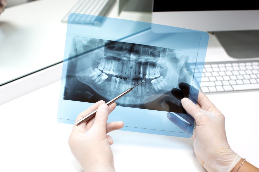 Root Canal Treatment in Lewisham